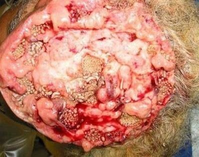 Parasiten im menschlichen Gehirn